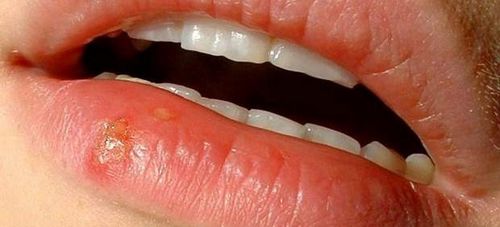 唇の風邪を治療するためのレシピ
