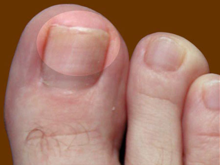 足と手の爪真菌のための最善の救済策